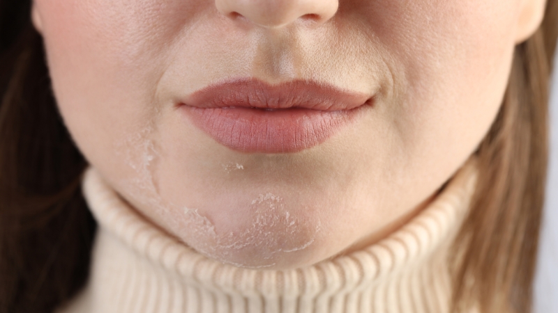 A woman’s chin shows flaky dry skin around breakouts, needing a professional hydration boost