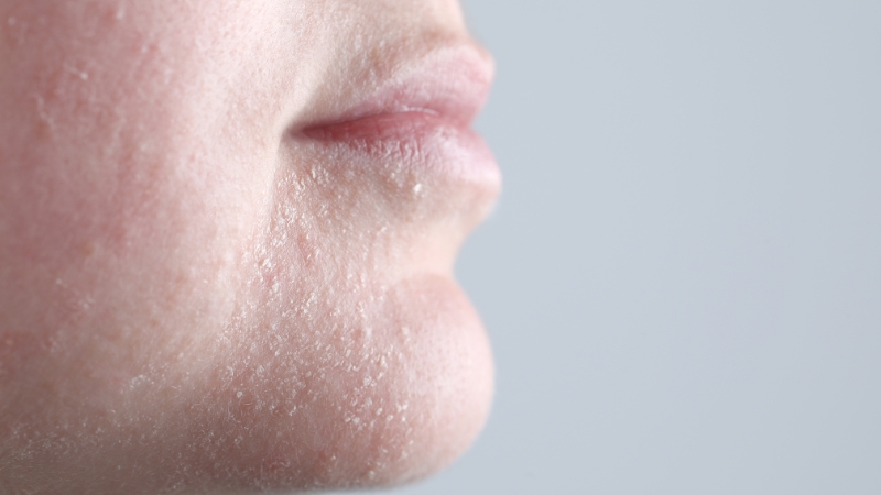 Close-up of flaky, dry skin on the lower face showing persistent dryness after moisturizing