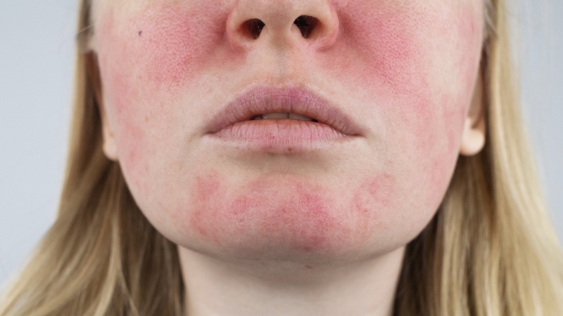 A woman’s face shows redness and irritation, clear signs her skin needs a professional hydration boost